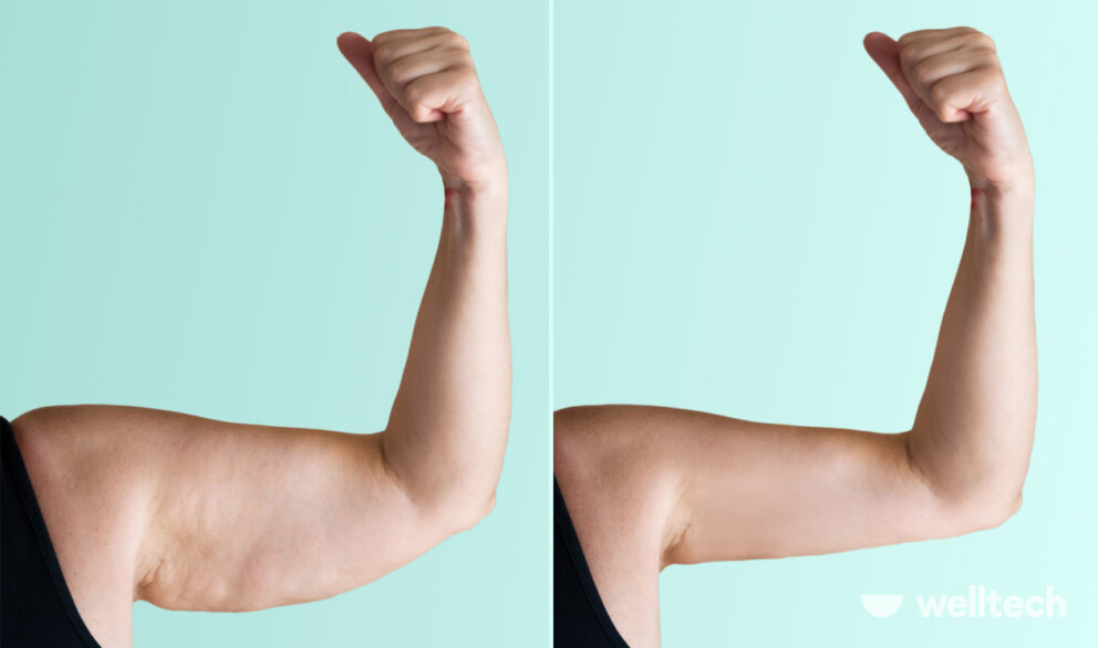 How To Tone Arms After Weight Loss